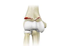 Elbow Fractures