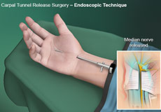 Endoscopic Cubital Tunnel Release