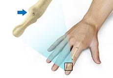 Finger Joint Fusion