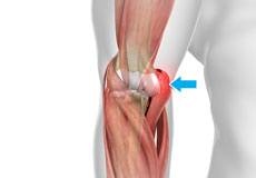 Golfer’s Elbow