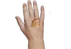 Microsurgical Flap Procedure of the Hand