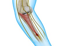 Radial Tunnel syndrome