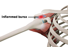 Rotator Cuff Bursitis