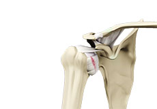 Shoulder Ligament Injuries