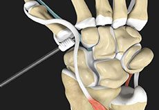 Trapeziectomy