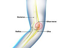 Ulnar Nerve Neuropathy